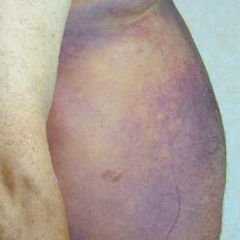 Significant dark bruising along patient’s chest and abdomen
