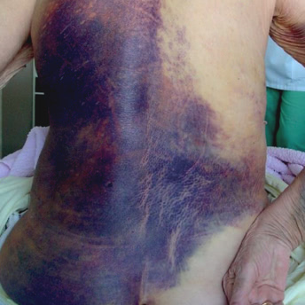 Signficant dark bruising along patient’s back and left hip