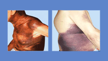 Pictures of a chest bleed and an abdomen bleed