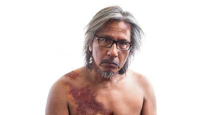Man with acquired hemophilia